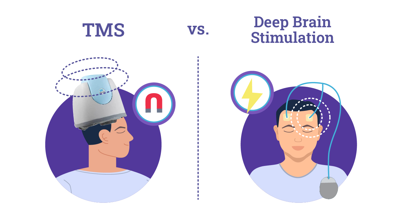 TMS VS Deep Brain Stimulation