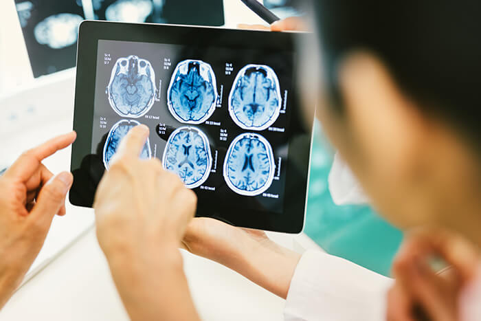 How Long Does It Take for TMS to Start Working for Depression?