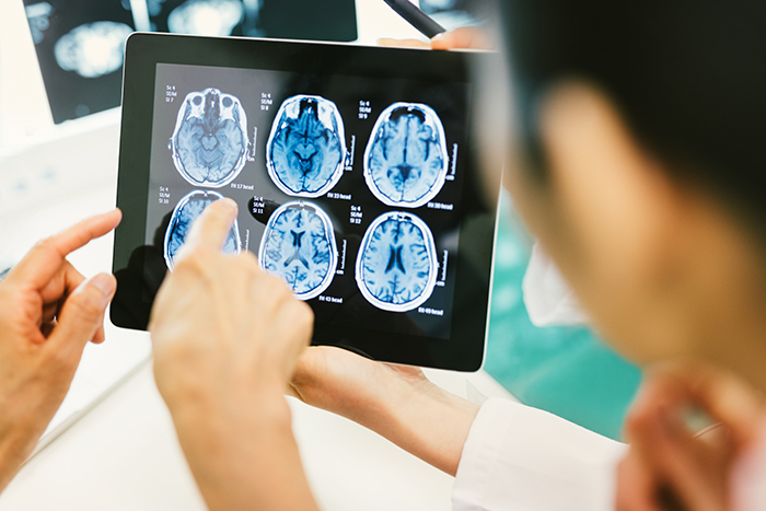 TMS-Results-Timeline-Can-Vary-According-To-Brain-Features