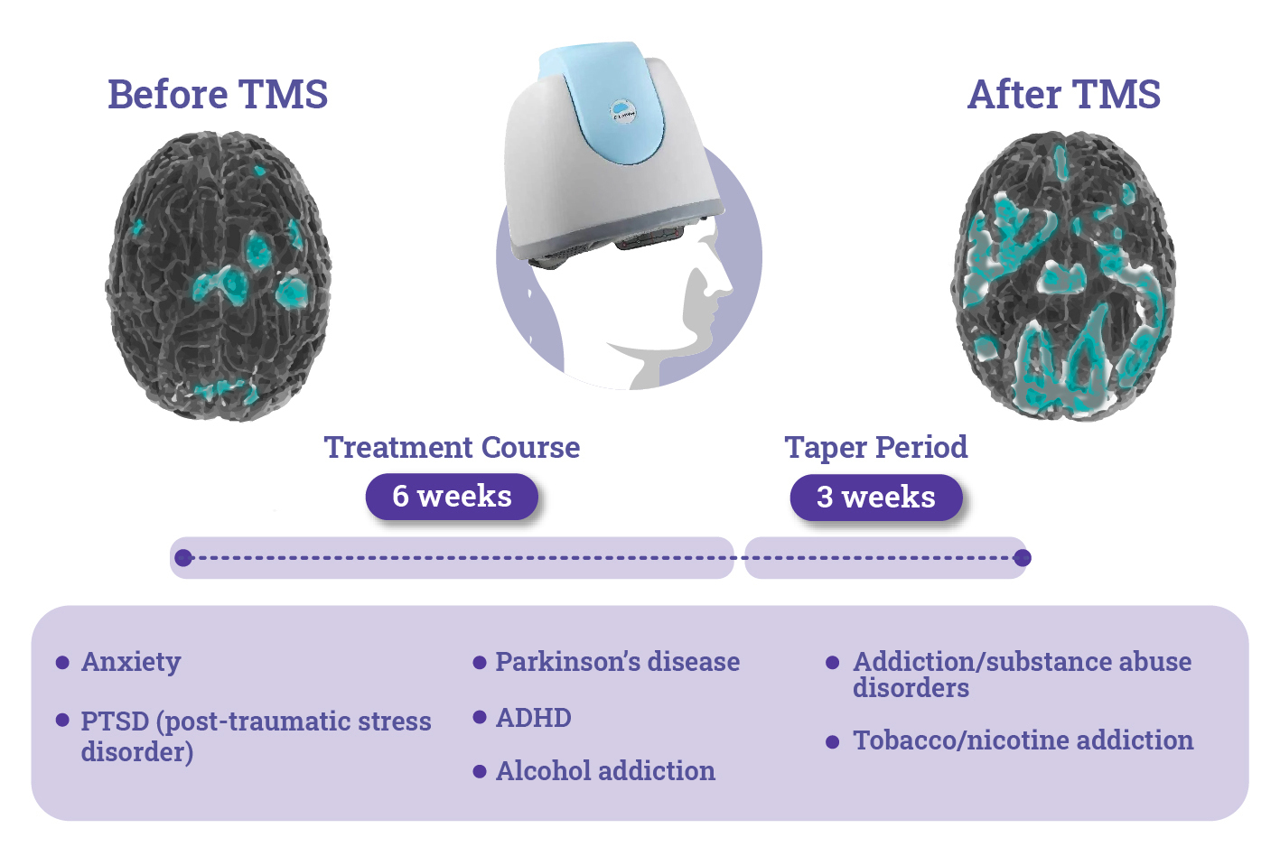 Tms therapy process